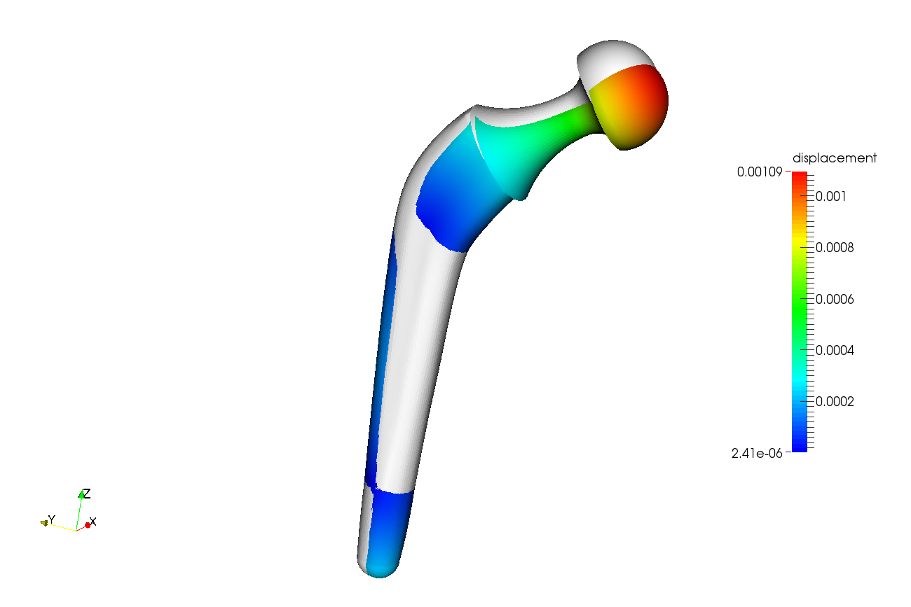 Hip replacement simulation image