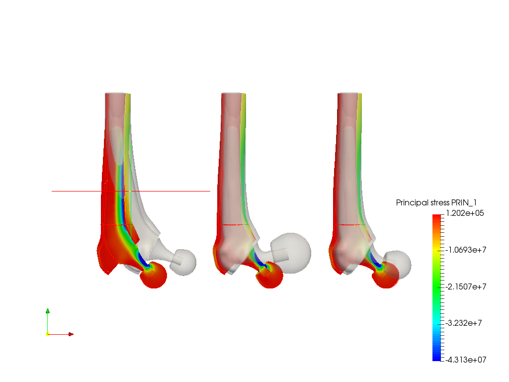 Hip joint prosthesis image