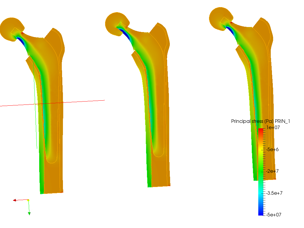 Hip joint prosthesis image