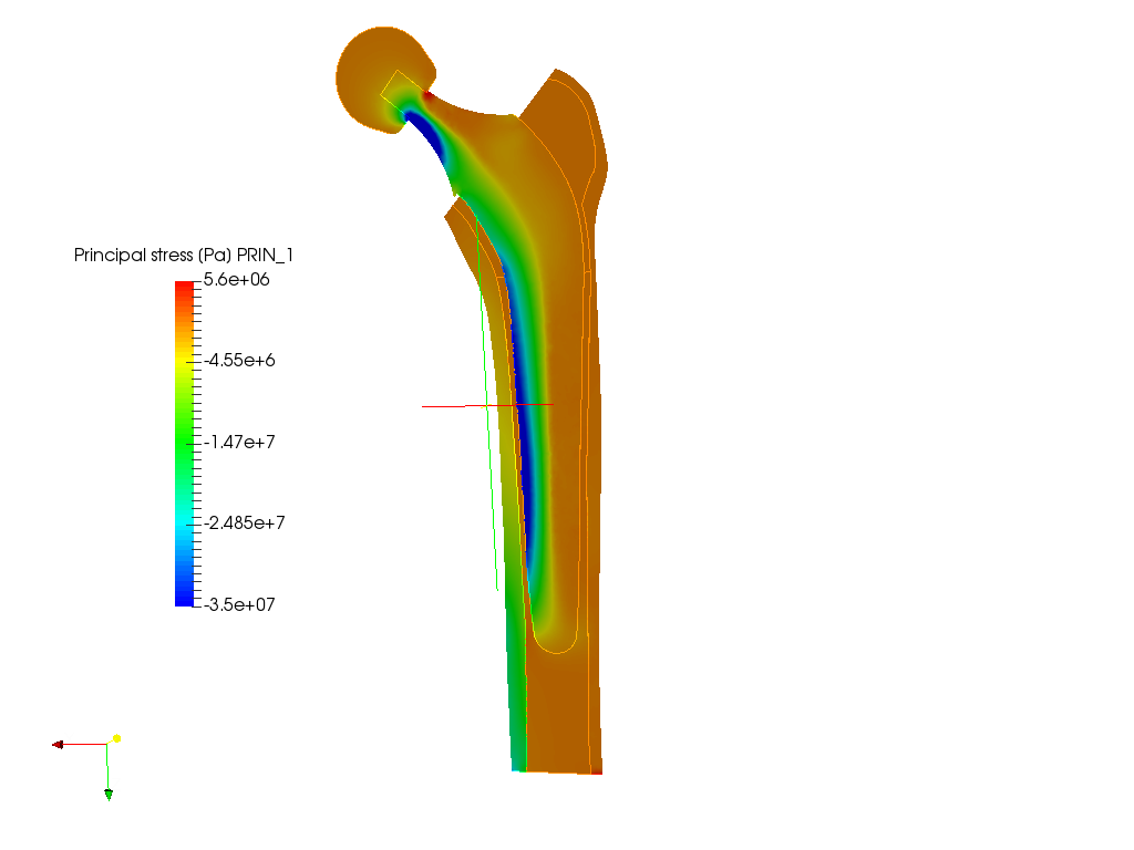 Hip joint prosthesis image