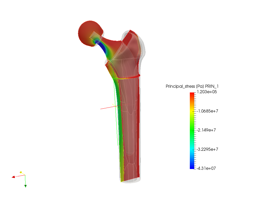 hip prosthesis image