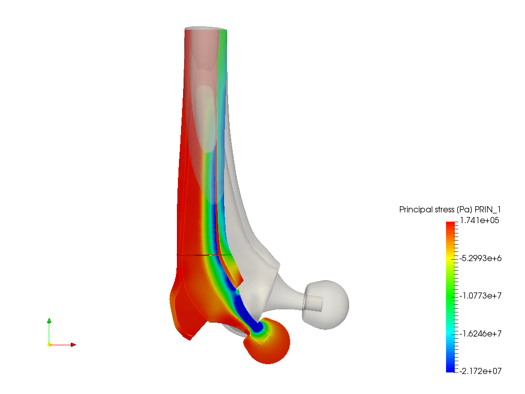 Hip Joint Prosthesis Analysis image