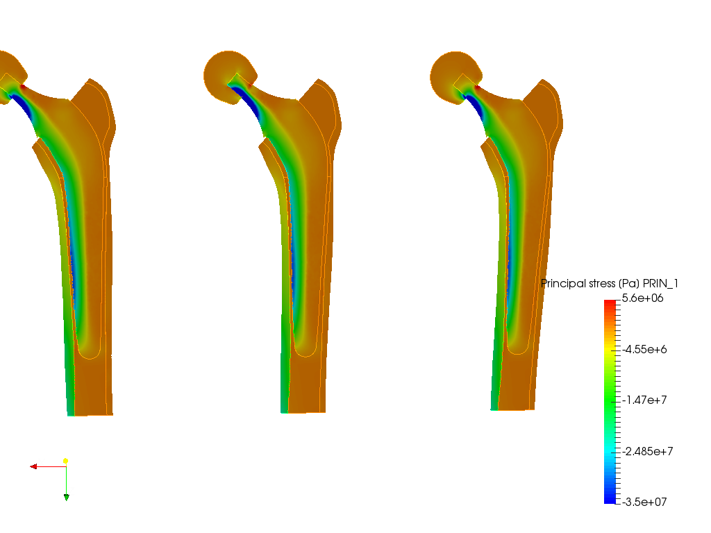 Hip joint prosthesis image