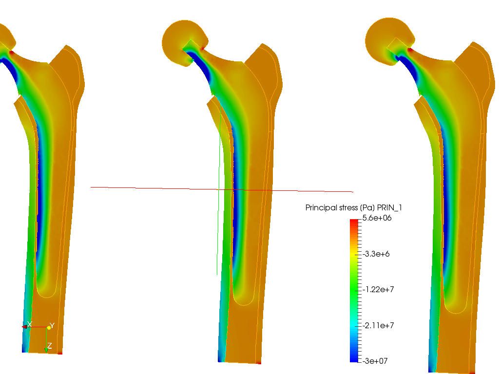 Hip joint prosthesis image