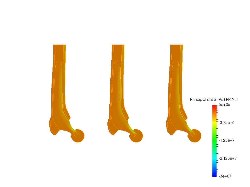 Hip joint prosthesis image