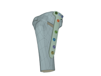 High Tibial Osteotomy Plate image