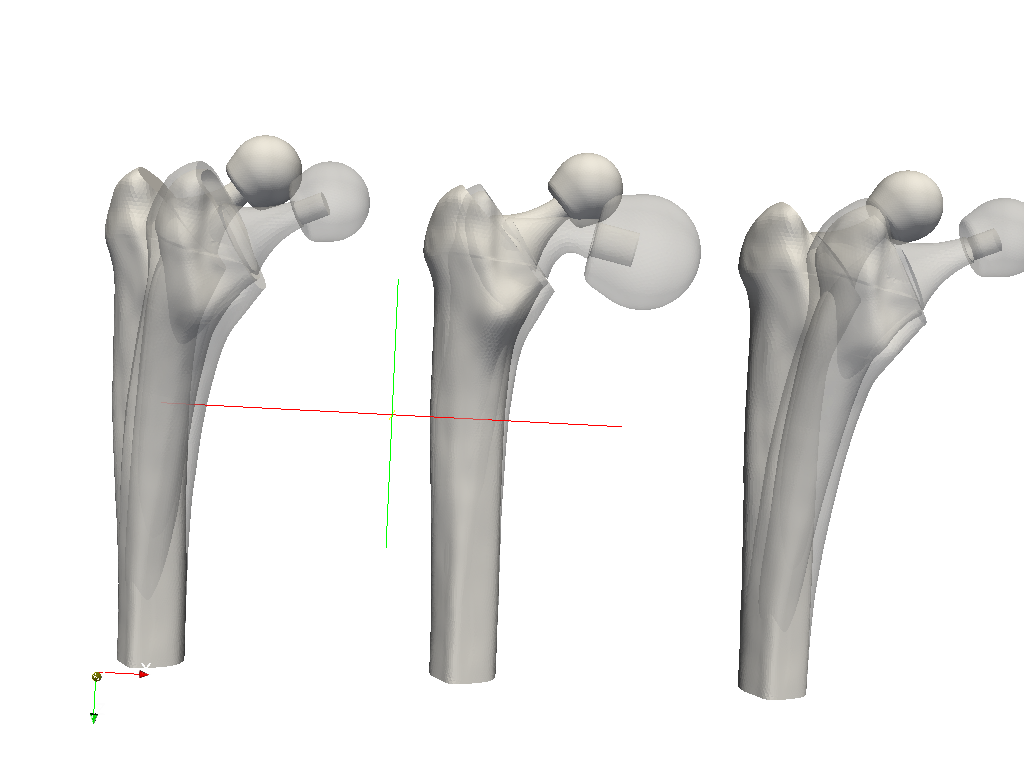 Hip joint prosthesis image