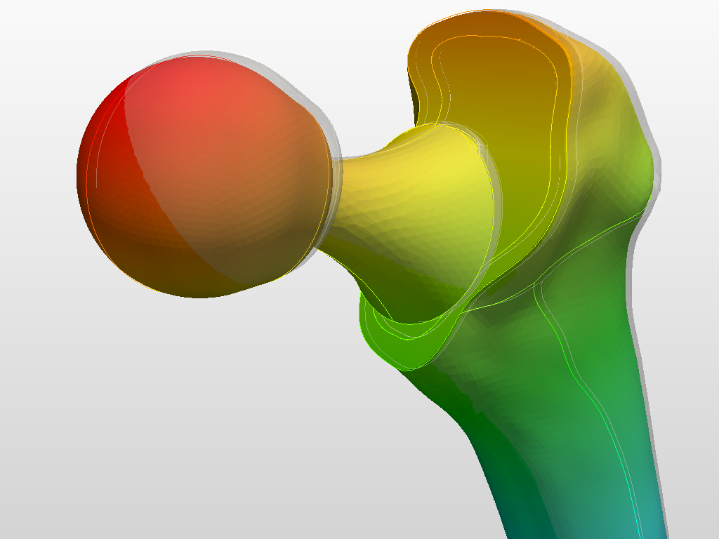 Hip joint prosthesis image