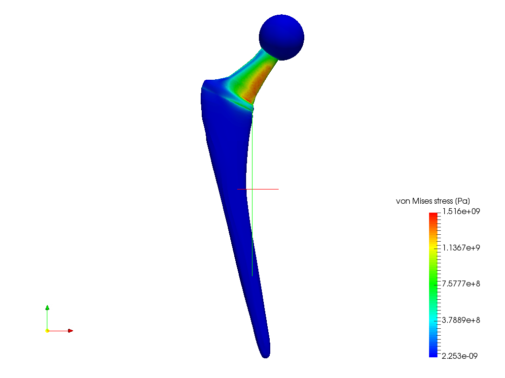 Hip Implant image