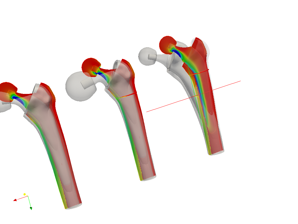 Hip joint prosthesis image