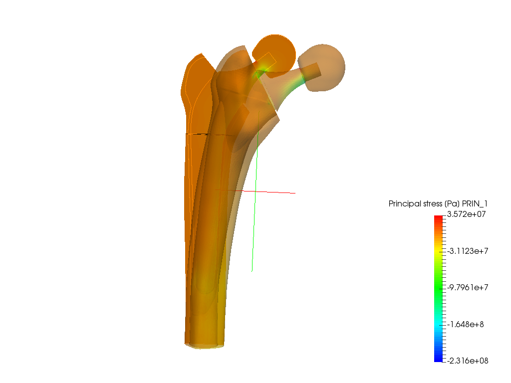 Hip joint prosthesis image