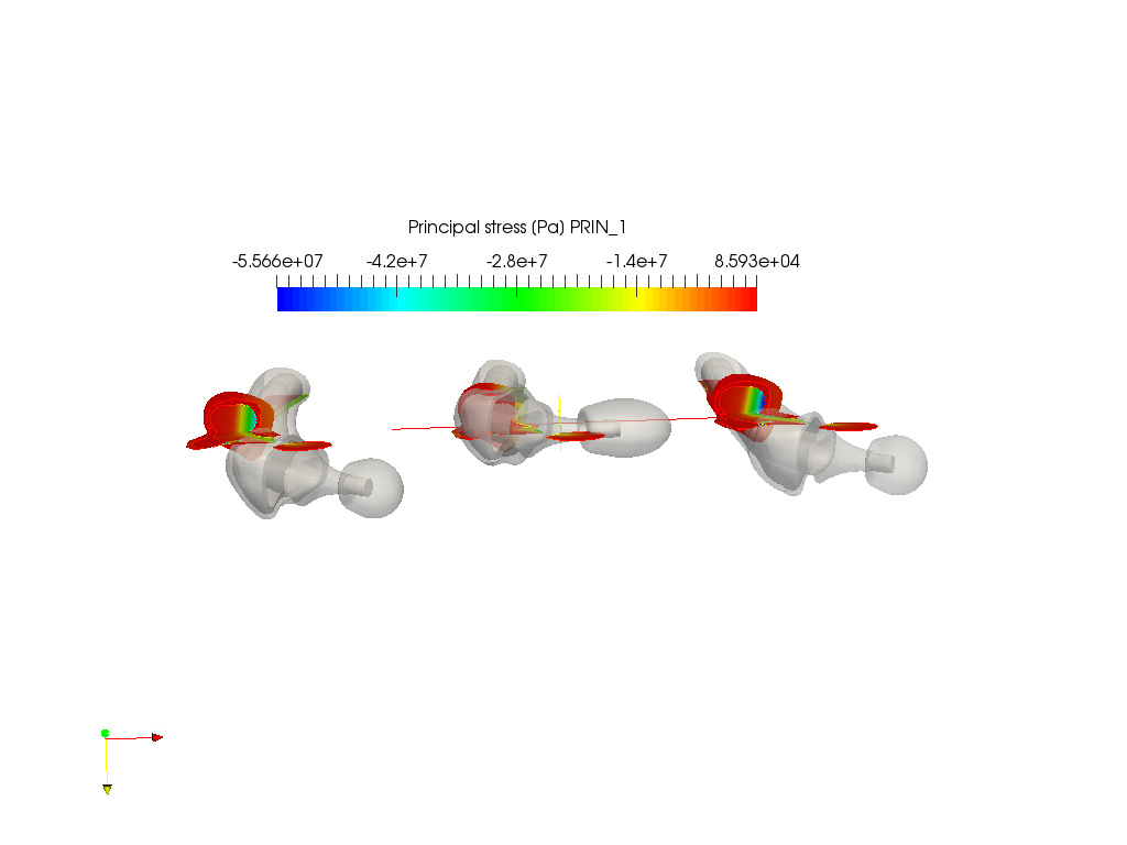 Hip joint prosthesis image