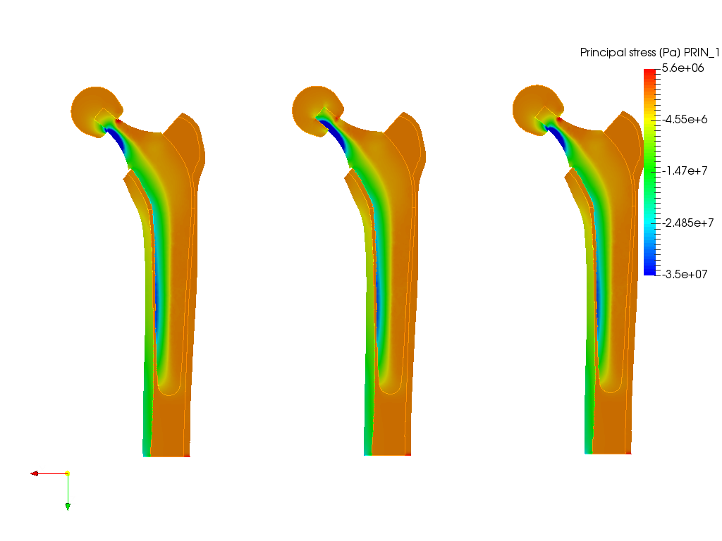 Hip joint prosthesis image