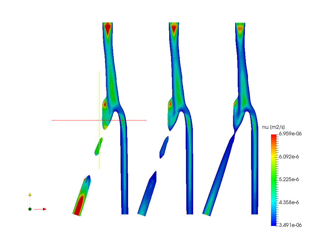 Blood Flow in a Carotid Artery Bifurcation image
