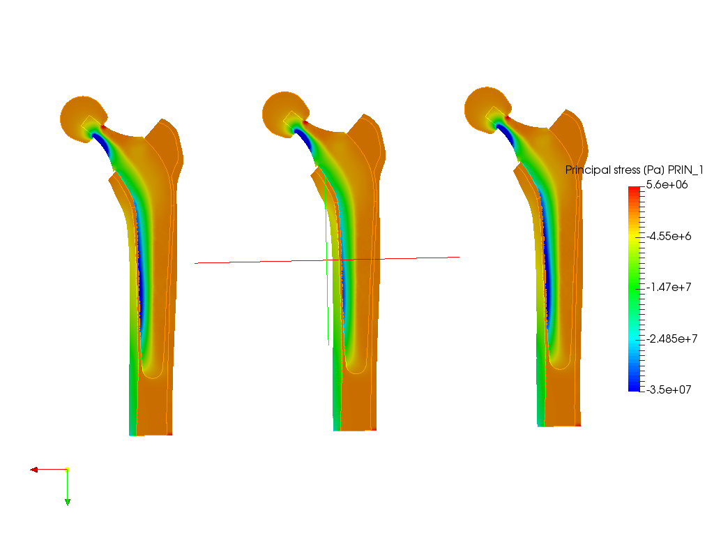 Hip Joint Prosthesis image