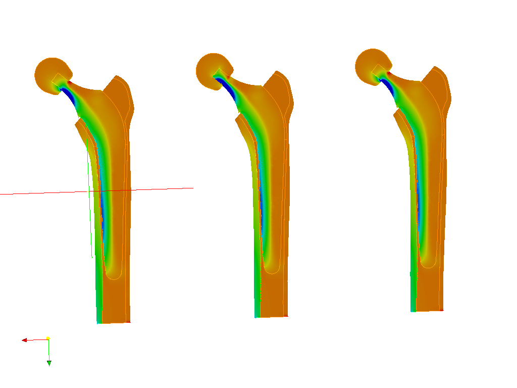 Hip joint prosthesis image