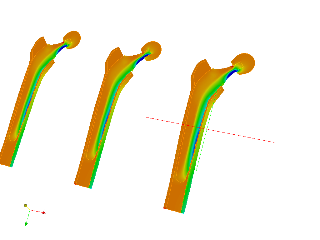 Hip joint prosthesis image