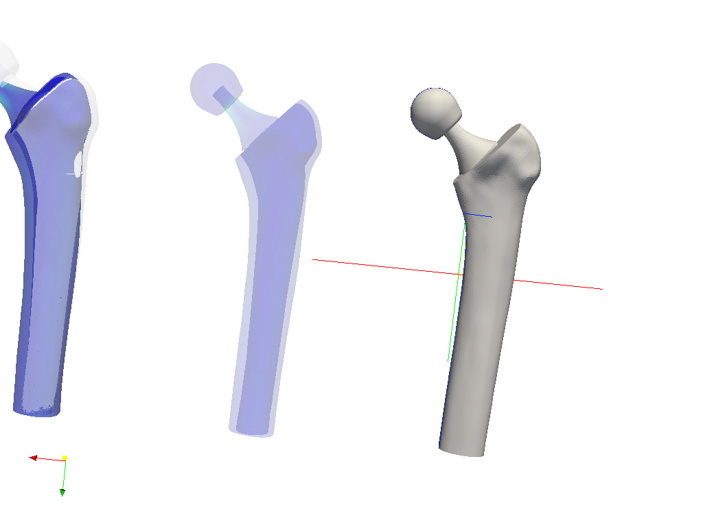 Hip joint prosthesis image